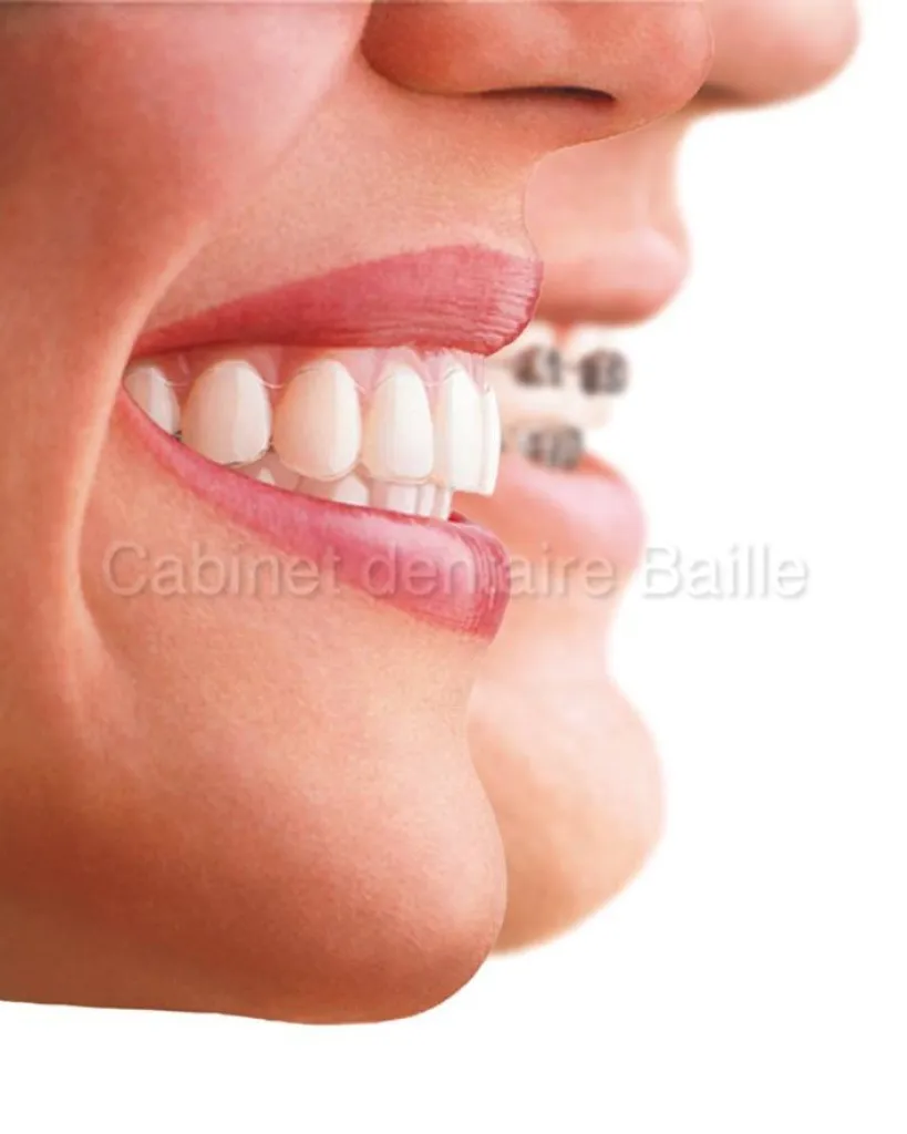 Orthodontie esthetique Marseille