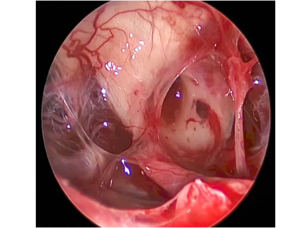 Vue opératoire lors d'un abord endoscopique endonasale