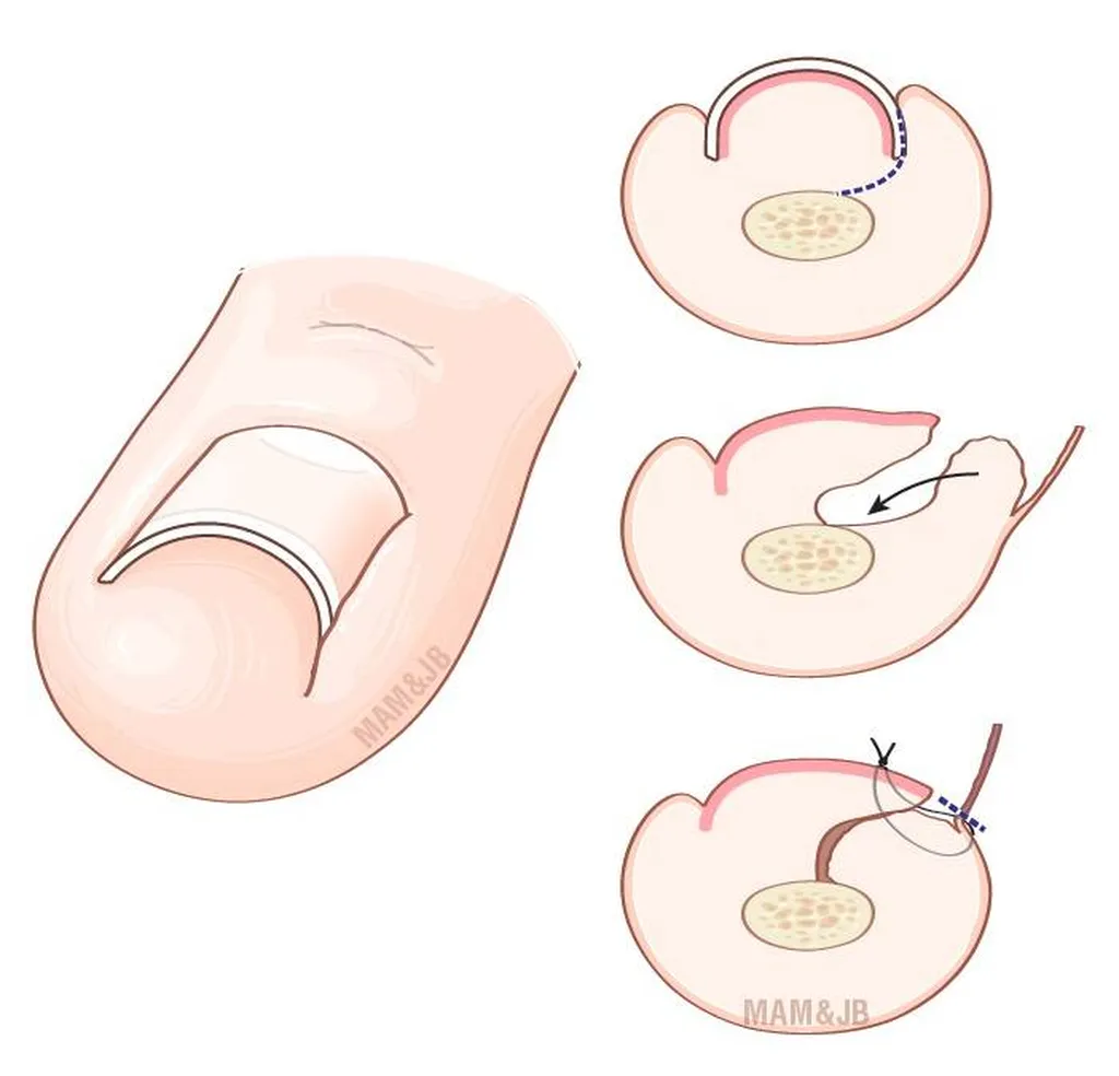 Publication d'un article, dès la rentrée de septembre, par le docteur Julien Beldame, chirurgien orthopédiste et traumatologue, sur le traitement d'une dystrophie unguéale