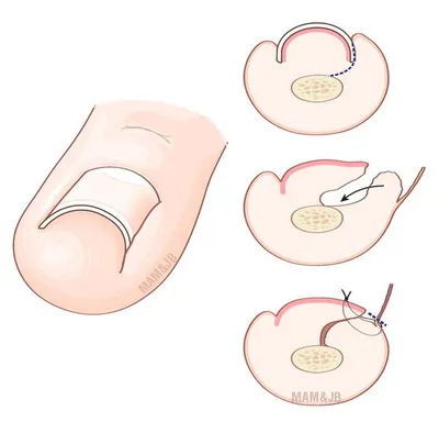 Publication d'un article, dès la rentrée de septembre, par le docteur Julien Beldame, chirurgien orthopédiste et traumatologue, sur le traitement d'une dystrophie unguéale