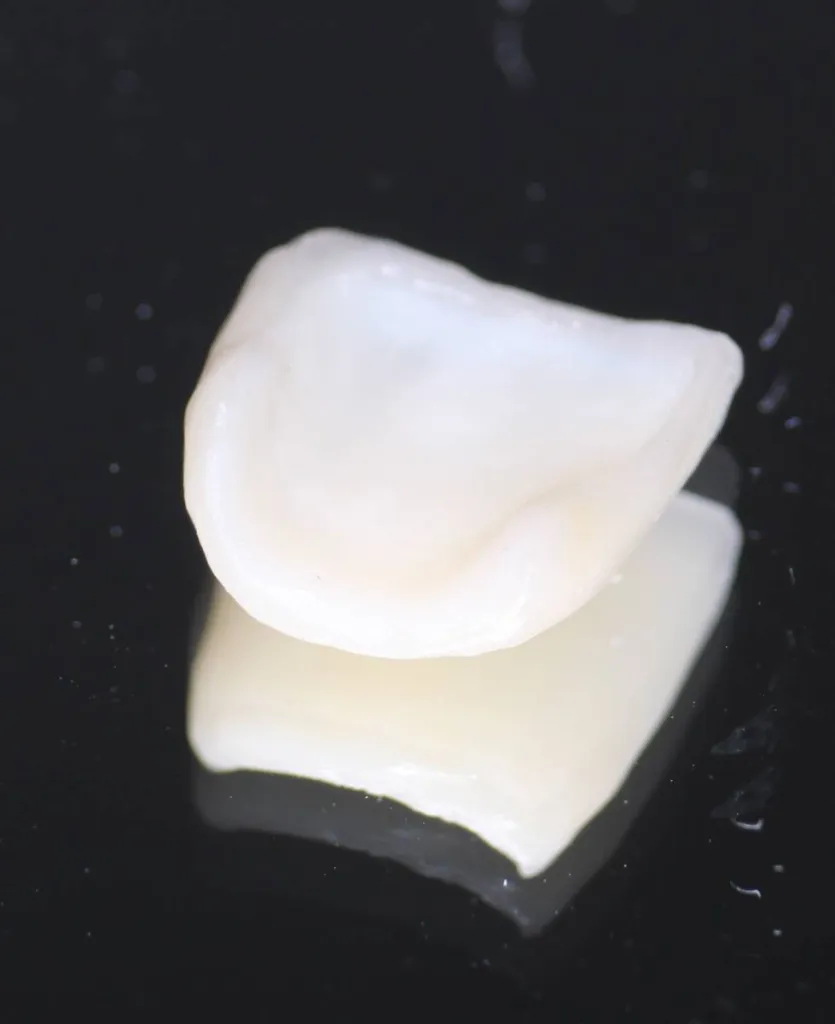 Cout traitement par facettes dentaires a marseille