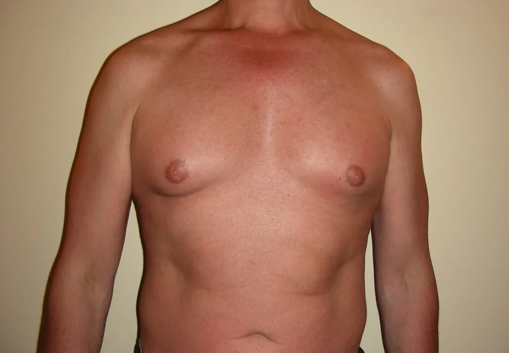 CHIRURGIE DE LA SILHOUETTE CHEZ L'HOMME, LA GYNCOMASTIE ET LE BODYLIFT