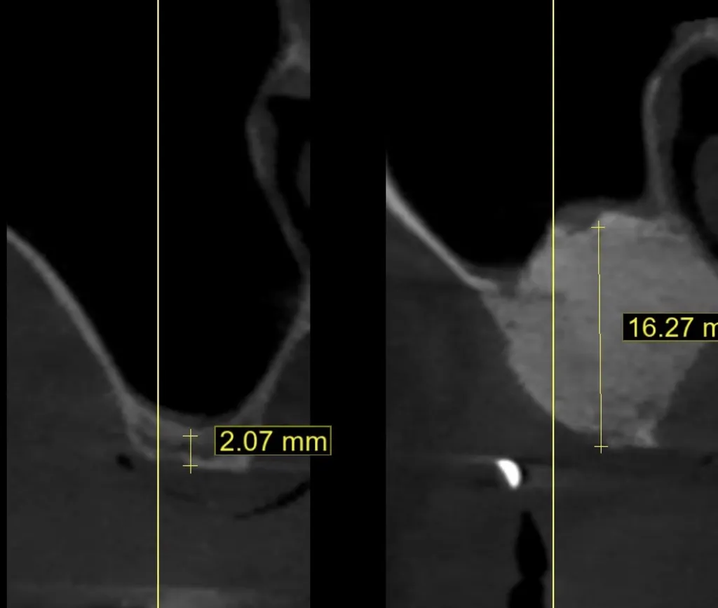 Greffe de sinus et sinus lift par spécialiste en implantologie Marseille