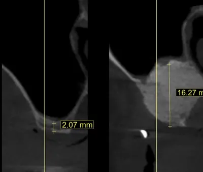 Greffe de sinus et sinus lift par spécialiste en implantologie Marseille