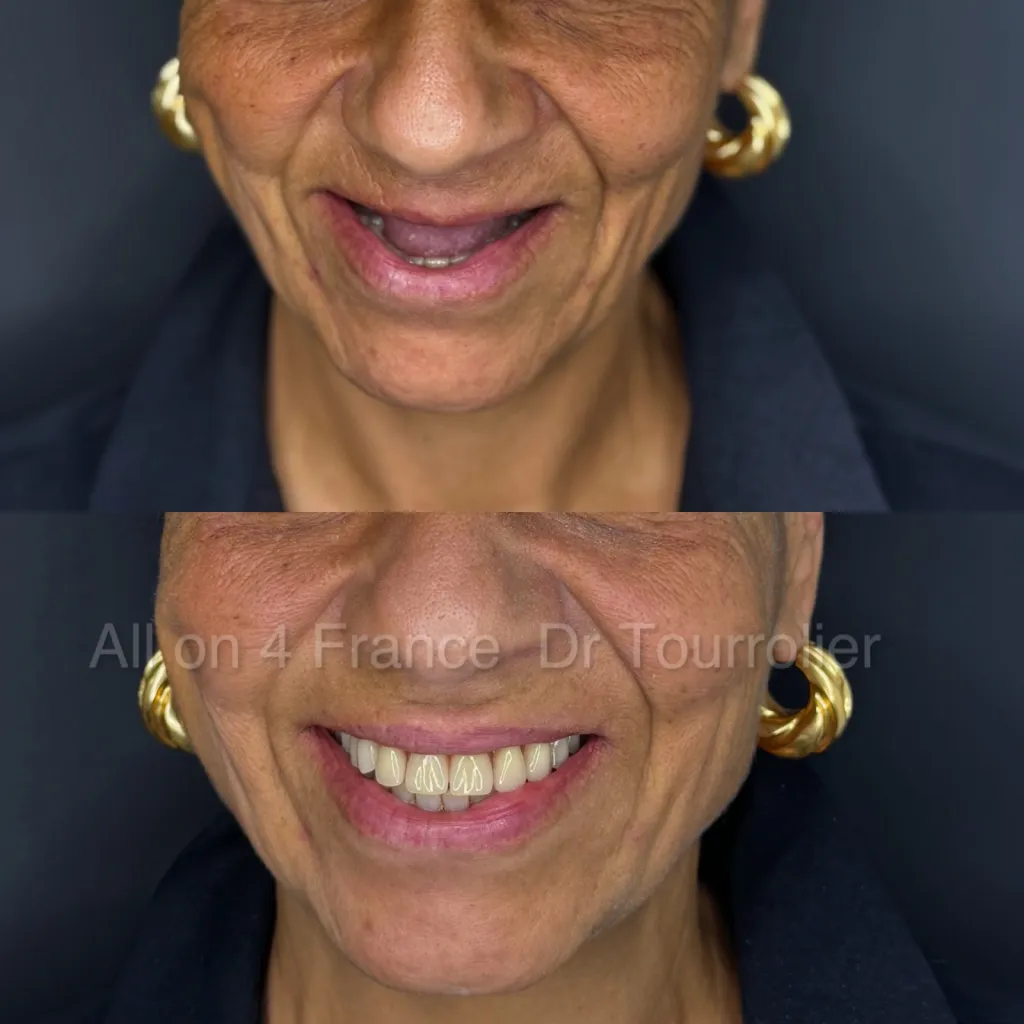 technique all on 6 et all on 4 par specialiste en France.dr Tourrolier didier