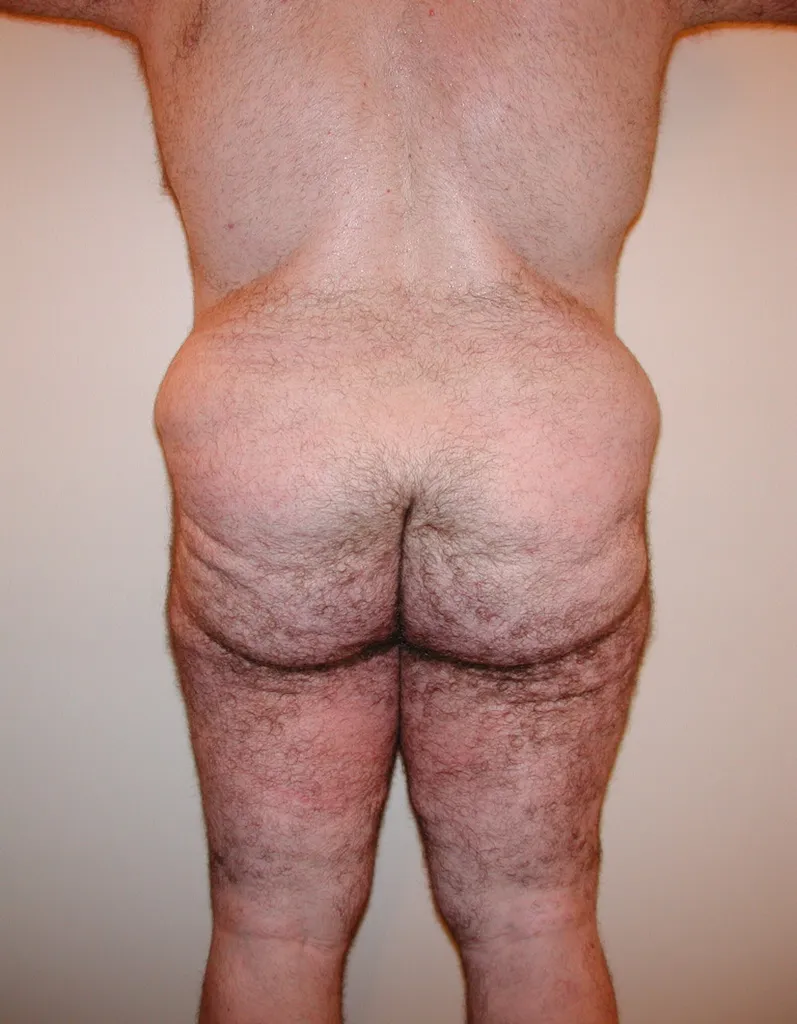 CHIRURGIE DE LA SILHOUETTE CHEZ L'HOMME, LA GYNCOMASTIE ET LE BODYLIFT