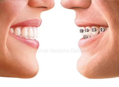 Gouttière orthodontie prix.Dr TOURROLIER Didier .13005.
