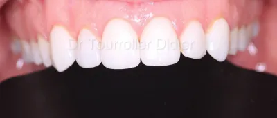 spécialiste facettes dentaires marseille