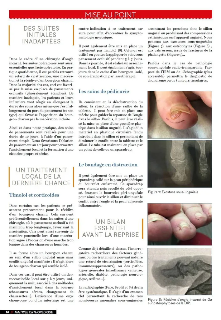 Publication du Dr Julien Beldame, chirurgien orthopédiste sur les récidives d'ongle incarné