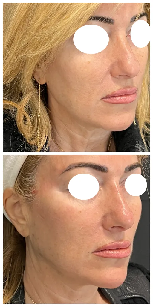 Full face paris 6 acide hyaluronique approche globale