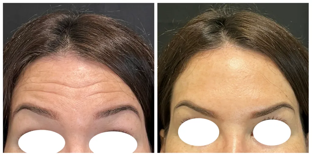 toxine botulique Paris 6 front Botox Azzalure 