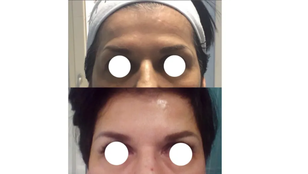 Injections d’acide hyaluronique pour lisser le front à Paris