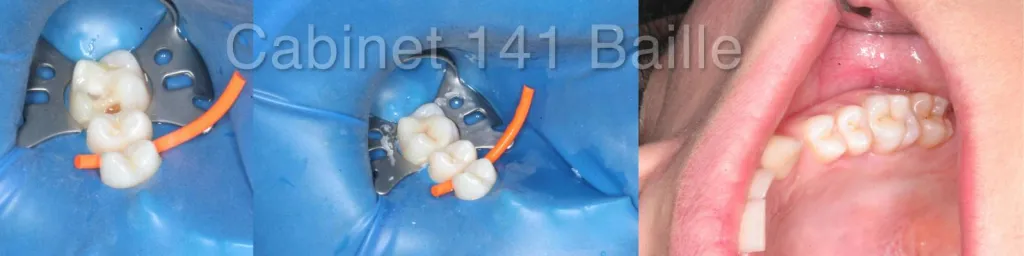 Onlays céramo-céramiques Prix Marseille