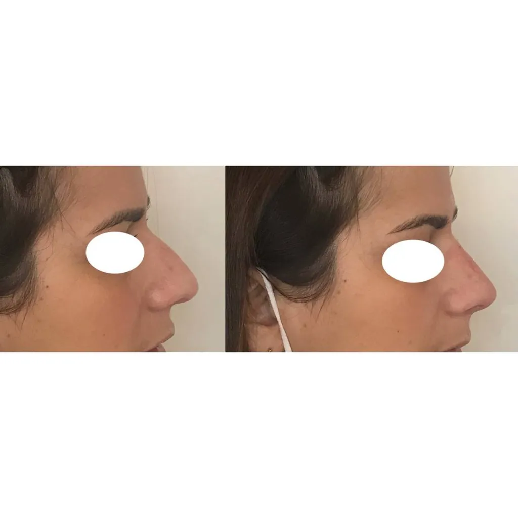 Rhinoplastie médicale acide hyaluronique Paris médecine esthétique
