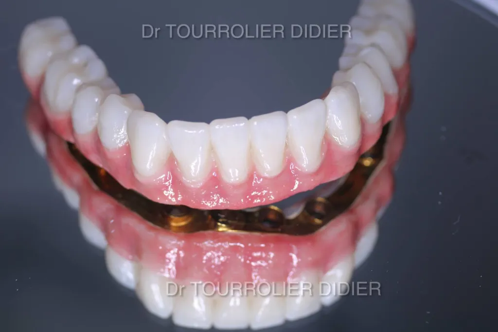 Implants pour remplacer toutes ses dents en une journée