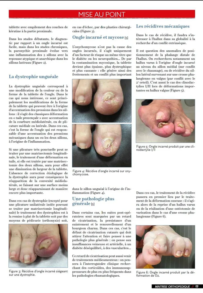 Publication du Dr Julien Beldame, publication d'ongle incarné