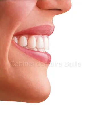 Spécialiste invisalign marseille