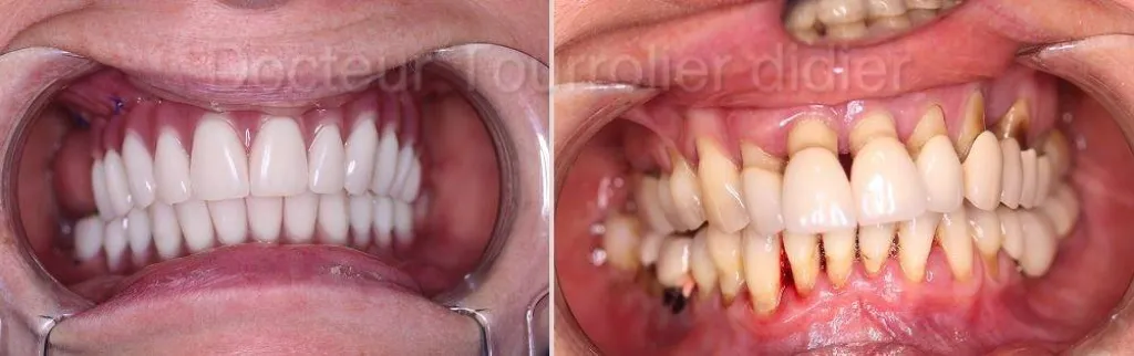 spécialiste implant dentaire avignon