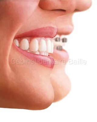 Aligner ses dents sans bagues-Marseille