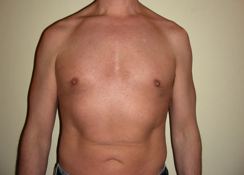 CHIRURGIE DE LA SILHOUETTE CHEZ L'HOMME, LA GYNCOMASTIE ET LE BODYLIFT