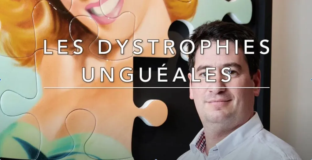 Poscast du Docteur Julien Beldame, chirugien orthopédiste, sur les traitements des dystrophies unguéales