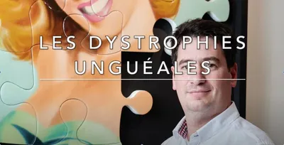 Poscast du Docteur Julien Beldame, chirugien orthopédiste, sur les traitements des dystrophies unguéales