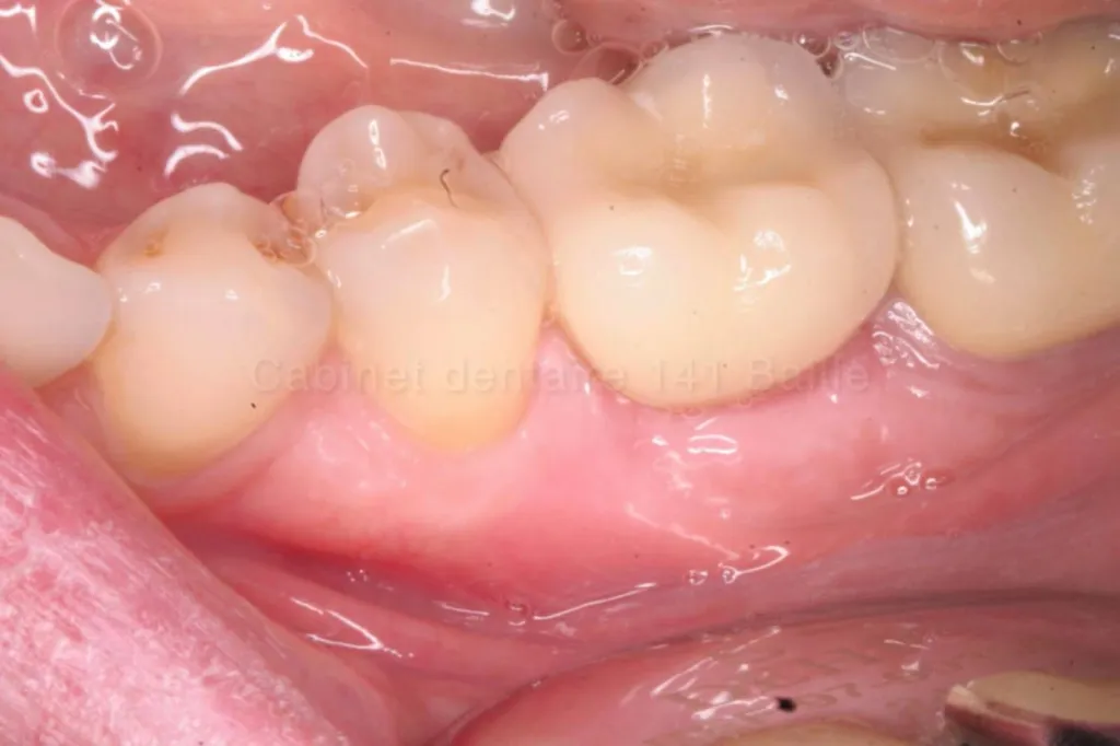 implant sur molaire cabinet 141 baille marseille