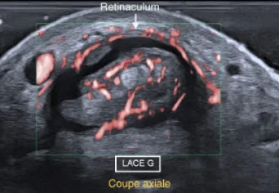 Echographie du Dome : Patient adressé pour impotence fonctionnelle du pouce avec fourmillement sur la face dorsale du 1er espace de la main et de la base du pouce.