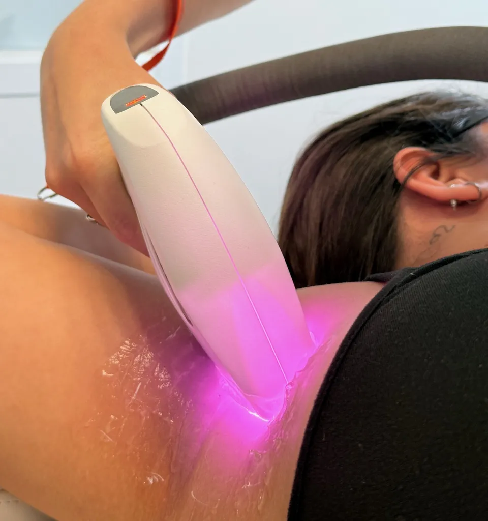 Offre exceptionnelle épilation laser : 4 + 2 offertes dès 2 zones !