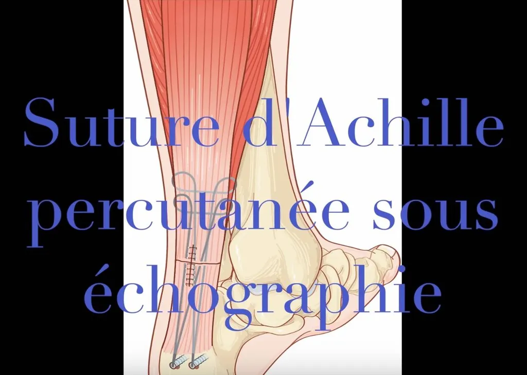 Rupture du talon d'Achille, Dr Julien Beldame, chirurgien orthopédiste à l'ICP Paris et la Polycliique de Picardie à Amiens