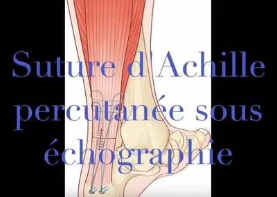 Rupture du talon d'Achille, Dr Julien Beldame, chirurgien orthopédiste à l'ICP Paris et la Polycliique de Picardie à Amiens