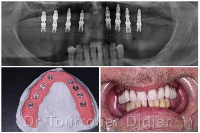 remplacer toutes ses dents par des implants en un jour