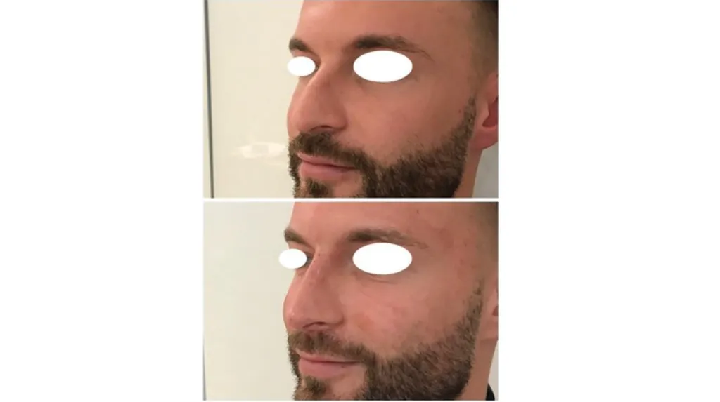 Rhinoplastie médicale avec acide hyaluronique pour homme à Paris