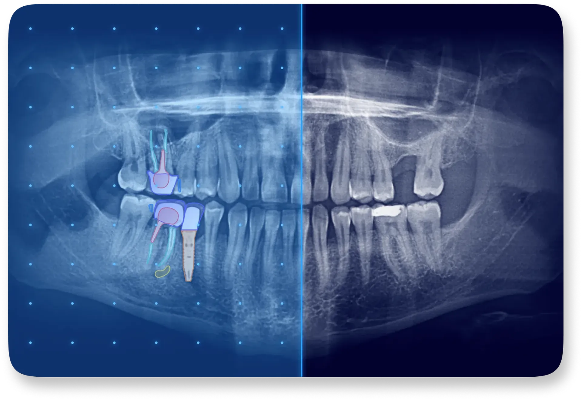 Intelligence artificielle dans le dentaire