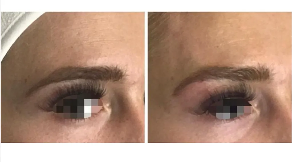 Rehausser la queue du sourcil avec un traitement par fils tenseurs résorbables à Paris