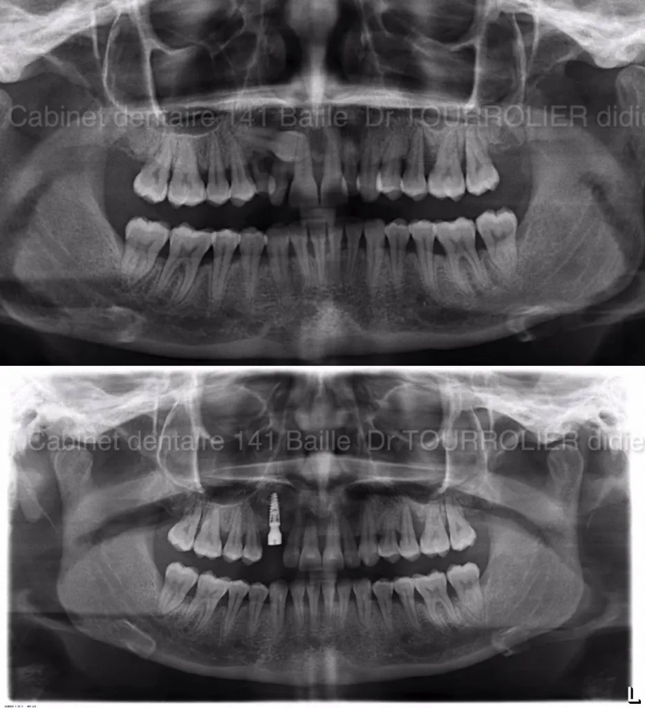 Traitement d'une canine incluse par Implantologie.Dr TOURROLIER Didier