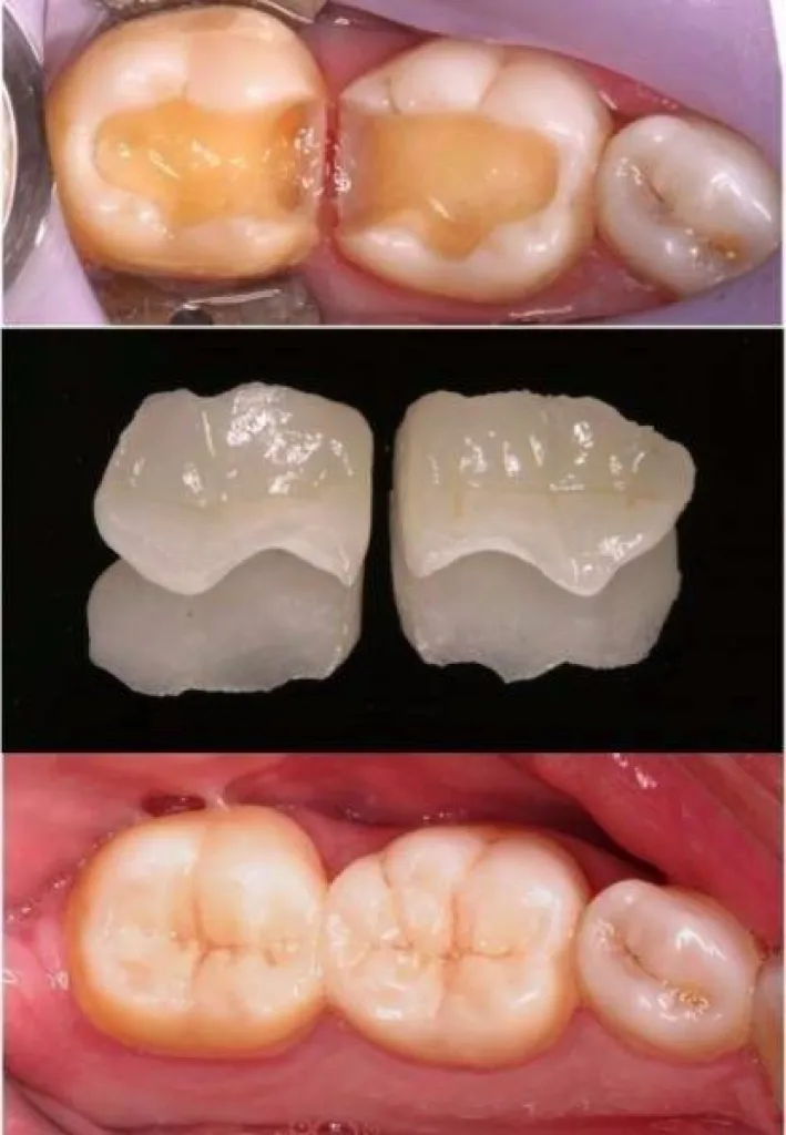Notre zone d'activité pour ce serviceGouttière invisalign