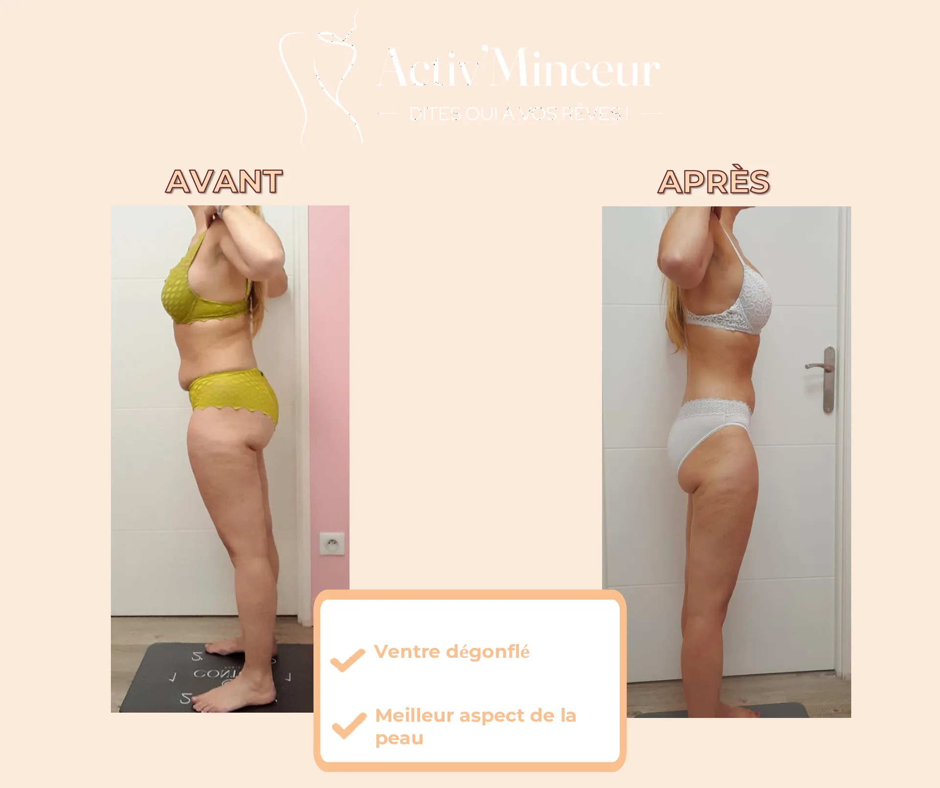Avant / Après de Justine (47 ans) : Le succès d'un bilan morphologique précis et de la synergie de tous les soins minceur proposés à Limas.