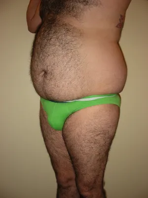 CHIRURGIE DE LA SILHOUETTE CHEZ L'HOMME, LA GYNCOMASTIE ET LE BODYLIFT