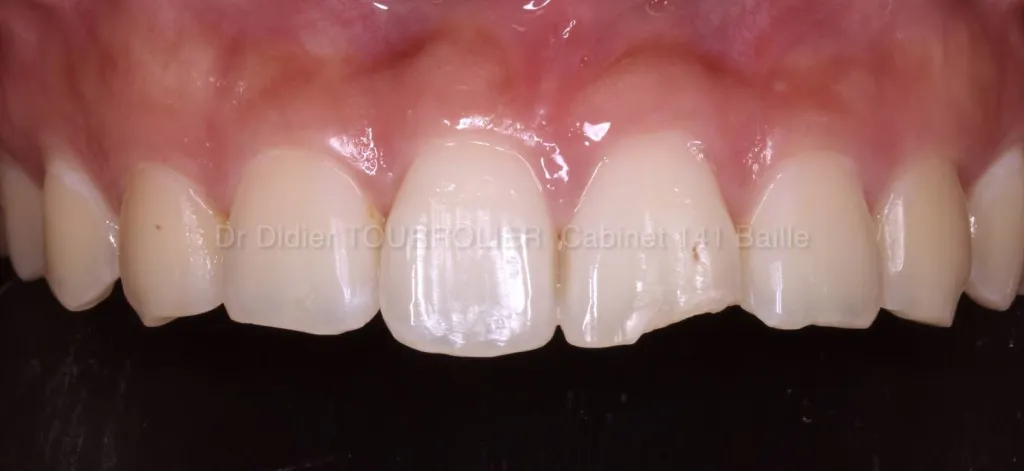 Dentiste spécialisé dans la pose de Facettes dentaires Toulon.Dr TOURROLIER DIDIER