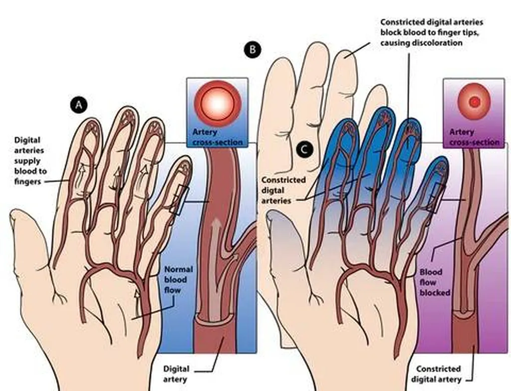 Le syndrome de Raynaud soigné efficacement par l'acupuncture à Lyon dans la région Auvergne Rhône-Alpes
