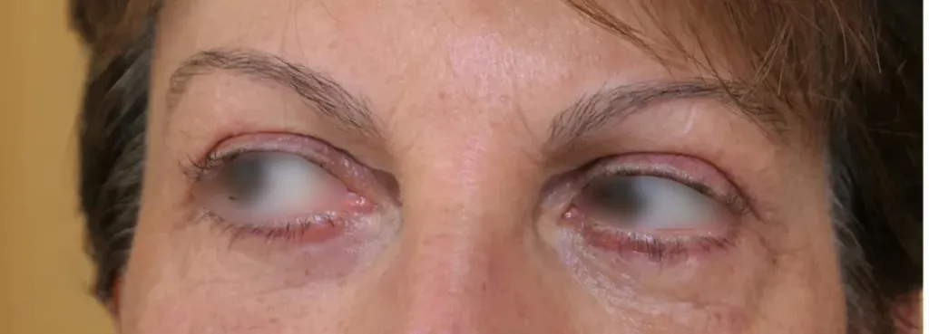 Blepharoplasty in France: rejuvenating and brightening the eyes with Dr Jean-François Pascal in Lyon