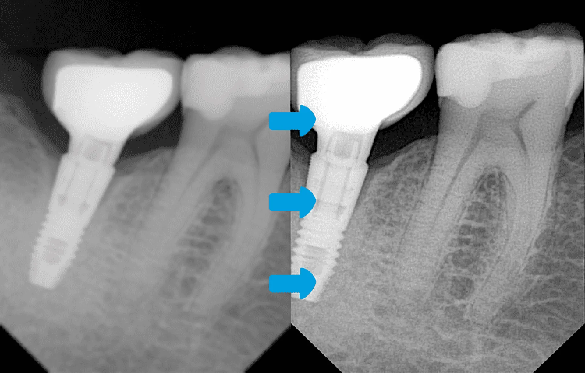 Owandy Opteo capteur intra-oral imagerie