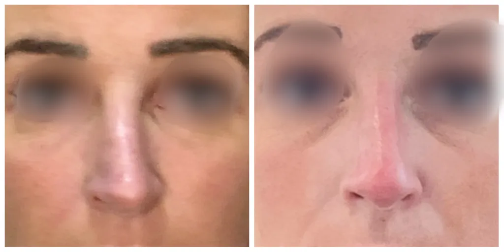 rhinoplastie médicale nez acide hyaluronique 