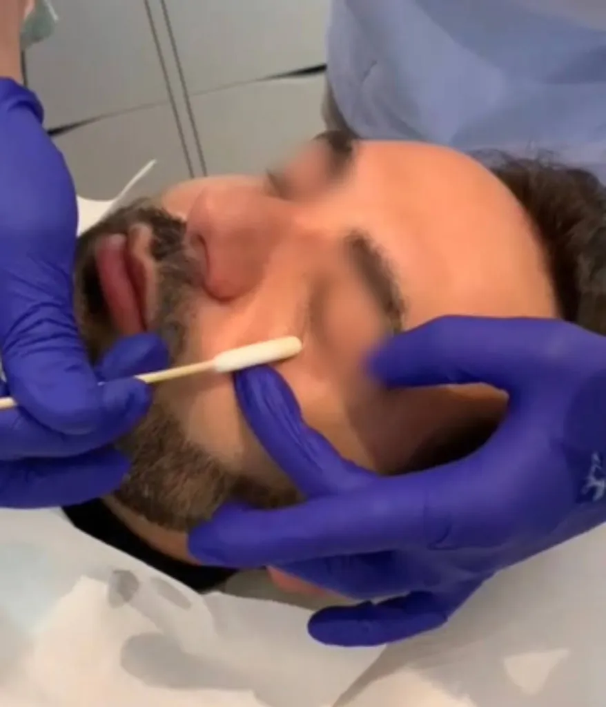 peeling qualité de peau, melasma, taches pigmentaires, cernes