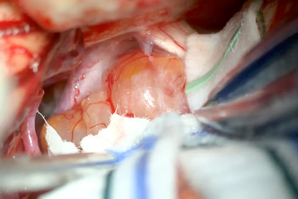 Vue opératoire lors d'une craniotomie