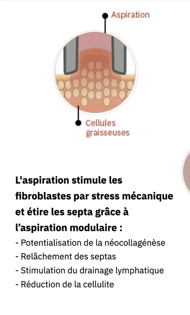 L'aspiration stimule les fibroblastes par stress mécanique et étire les septa grâce à l’aspiration modulaire