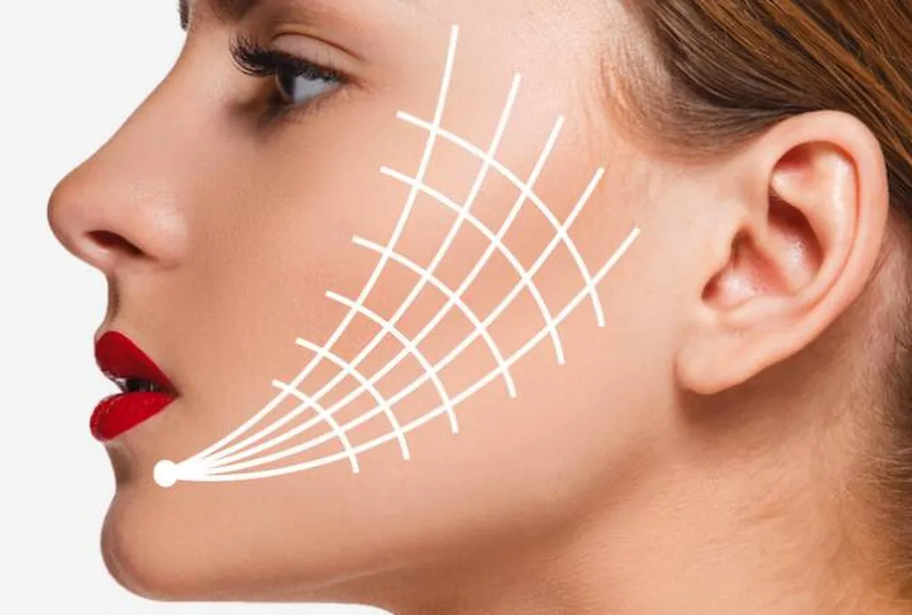 fils tenseurs radiesse sculptra profhilo 