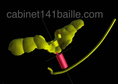 Chirurgie implantaire guidée marseille
