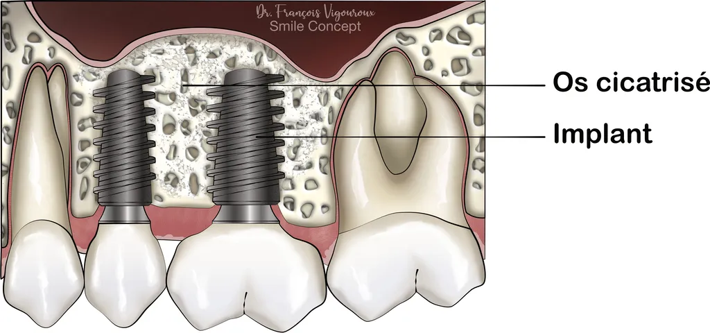 RECONSTRUCTION OSSEUSE GREFFE SINUSIENNE OU SINUS-LIFT